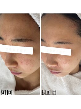 プラセル(Placer)/見た目が変わると気持ちも変わる