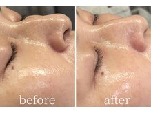 オパール 大阪梅田(op_l)/梅田/毛穴洗浄/フェイスワックス