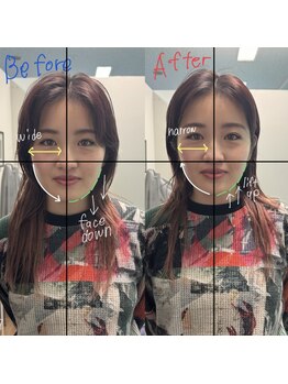 サララ(SALALA)/小顔矯正