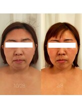 ミールーム(mi room)/フェイシャルマシン２回