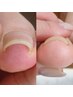 【巻き爪矯正/親指2本】男性も◎ご相談のうえ+当日施術