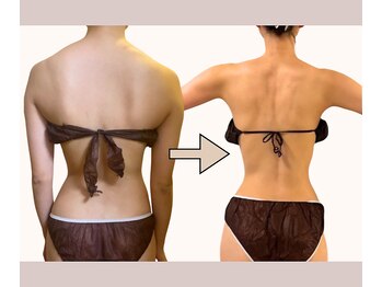 アトランティカ(ATLANTICA)/オーダーメイド痩身