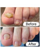 フットファースト 名古屋池下店/爪の厚み調整で綺麗な爪に