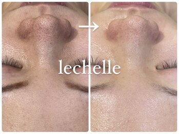 レシェルサロン(Lechelle Salon)/ハーブピーリング+オプション