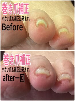 巻き爪補正