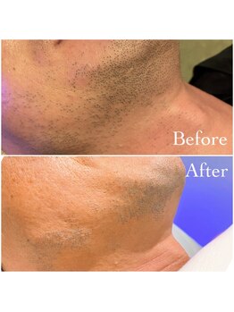 ミシェル(Michelle)/お髭脱毛