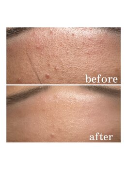 オーシャンブルー 長崎店(OCEAN BLUE)/ダイヤモンドピーリング症例