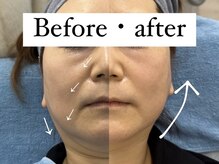 リメイクビューティークリニック(REMAKE BEAUTY CLINIC)/お顔の脂肪にお悩みの方