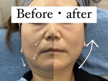 リメイクビューティークリニック(REMAKE BEAUTY CLINIC)/お顔の脂肪にお悩みの方