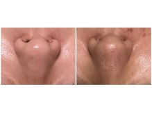 フィカス(FICUS)/美肌ケアはハーブピーリング！