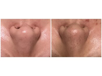 フィカス(FICUS)/美肌ケアはハーブピーリング!