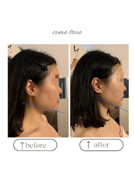 モテ肌 小顔コルギサロン カムトゥルー(come true)/コルギ/20日間で4回の施術結果