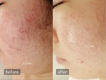 ムーマイニー(m maini)/本格肌質改善