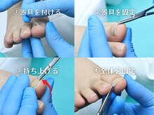 巻き爪補正店 大阪京橋店