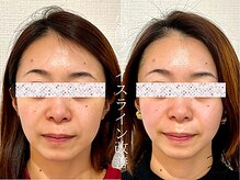 フレキシ 表参道(Flexi)/小顔コルギ＋肩こり整体