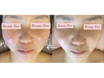 ビューティーツリー(Beauty Tree)/浮腫みたるみから激変！