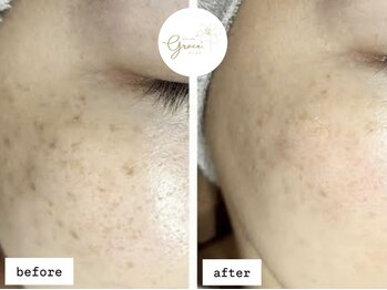 グレイス(Grace)/集中シミケア