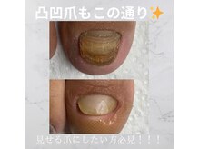 シャドウ(shadow)の雰囲気（こんなに分厚い肥厚爪も綺麗になります！！）