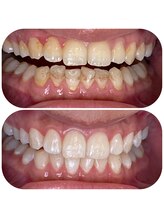 ホワイトニングカフェ 名古屋栄店(WhiteningCafe)/★症例写真