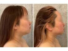 クラージュ/小顔矯正×脂肪分解フェイシャル