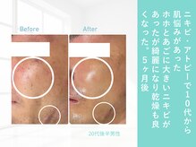 ルナティアラ(LUNAティアラ)/男性ニキビ・乾燥