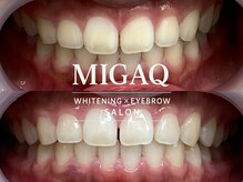 ミガク 京都四条大宮店(MIGAQ)/京都/四条大宮/ホワイトニング