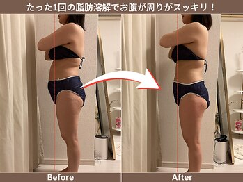 ゼロ シロカネ(ZERO SHIROKANE)の写真/【最短結果出し】最新痩身マシン導入★上半身集中コース120分￥22000→￥10900/[レモンボトル]&[RED SHOT]も