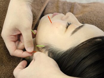 ソリーシェ鍼灸院(SORRISCE)/お試し美容鍼もご用意^^