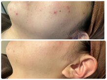 ブリリアント(Brilliant)/結婚式までにニキビケア