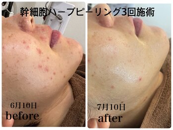 デューン 蕨店(Dune)/ハーブピーリング×よもぎ蒸し