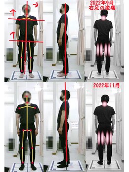 姫路なごみ整体院 なごみ鍼灸院/改善例（ふともも裏の張り）