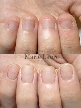 マリーロール 淀屋橋本店(Marie Laure)/自爪育成/深爪矯正/ネイルケア