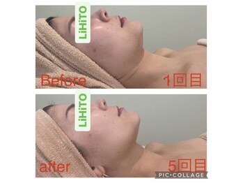 リヒト(LiHiTO)/光フェイシャル★たるみスッキリ