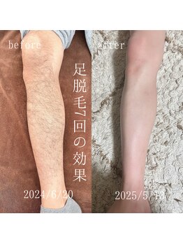 アゲハ(ageha)/メンズ/足脱毛
