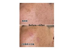 ５日～１週間ほどで浮き上がったシミは瘡蓋となって剥がれます。