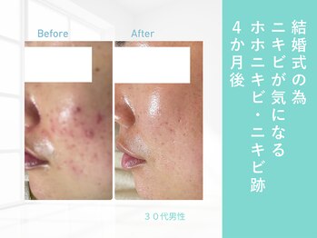 ルナティアラ(LUNAティアラ)/男性ニキビ・毛穴