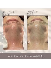 ヘッドミント 福井店/ハイドロフェイシャル