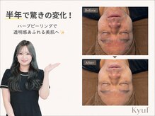 キュル(Kyul)の雰囲気（ハーブピーリング半年でこちらの変化です。さらに美肌へ）