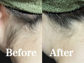 フィールグルック(Viel Gluck)/学生さんに人気えり足脱毛！