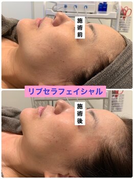 プリュネル(Prunelle)/プラズマシャワー