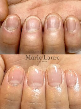 マリーロール 梅田店(Marie Laure)/自爪育成/深爪矯正/ネイルケア