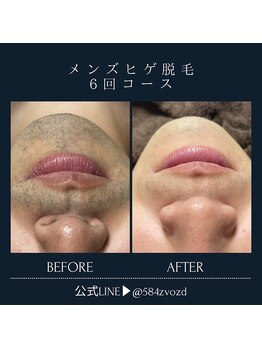 フィールグルック(Viel Gluck)/ヒゲ脱毛