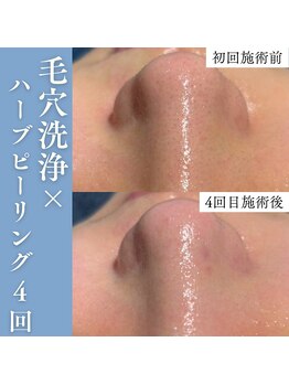 エミーニー(emiiny)/毛穴の開きにはハーブピーリング