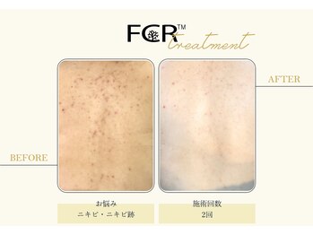 ハーバル 新宿店(HERBAL)/最強★韓国FCRハーブピーリング