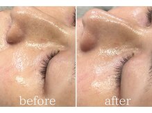 オパール 大阪梅田(op_l)/梅田/毛穴洗浄/フェイスワックス