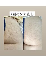 スキンプローズ(skinprose)/ヒップハーブピーリング・ハード