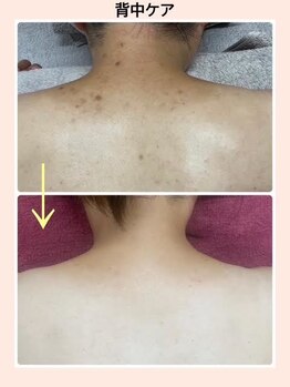 リファイン(REFINE)/悩める背中ニキビも・・・