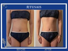 ビテュセスリー はなみずき店(美tusais3)/【痩身・ダイエット】ボディケア