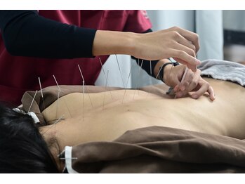 北京堂鍼灸首里 いじゅ治療院/首～腰へ脊柱起立筋にしっかり鍼
