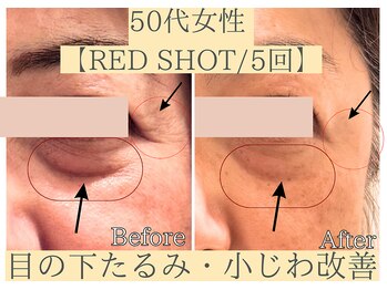 エトワール(etoile)/目の下たるみ.小じわ改善|天王寺